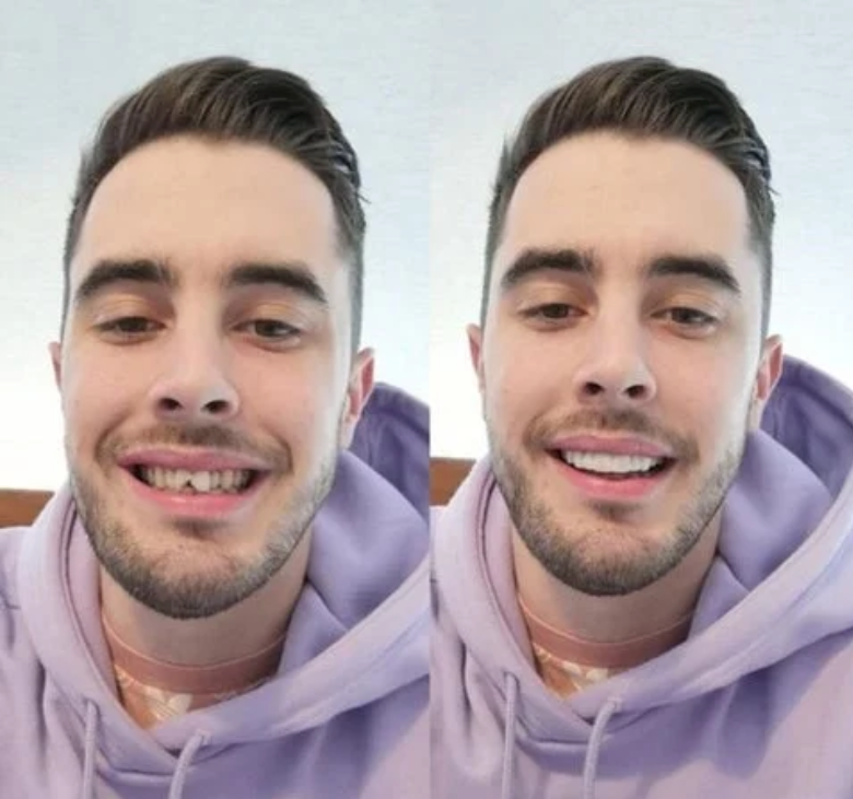 C. Smile Max ORIGINAL ™️ - Vuelve a Sonreír con confianza